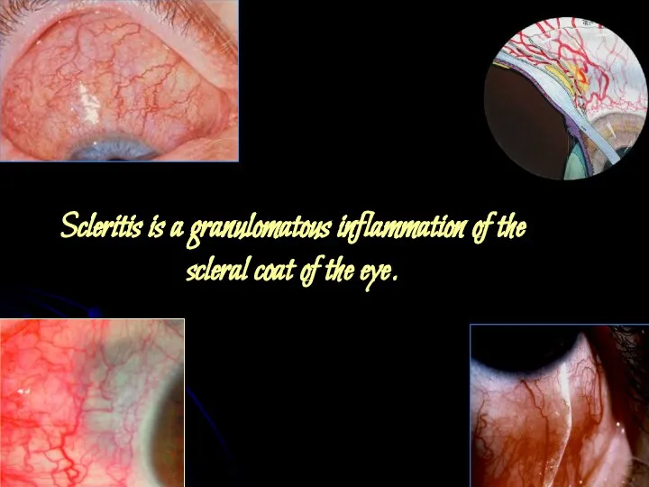 Scleritis is a granulomatous inflammation of the scleral coat of the eye.