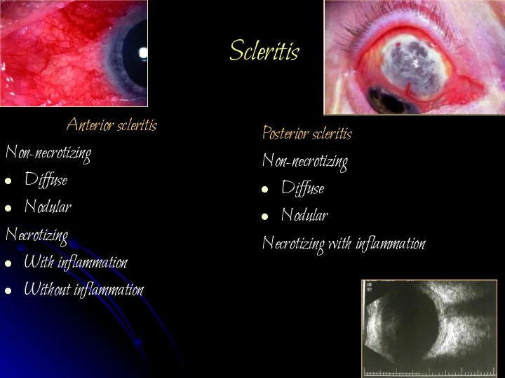 Scleritis Anterior scleritis Non-necrotizing Diffuse Nodular Necrotizing With inflammation Without inflammation Posterior