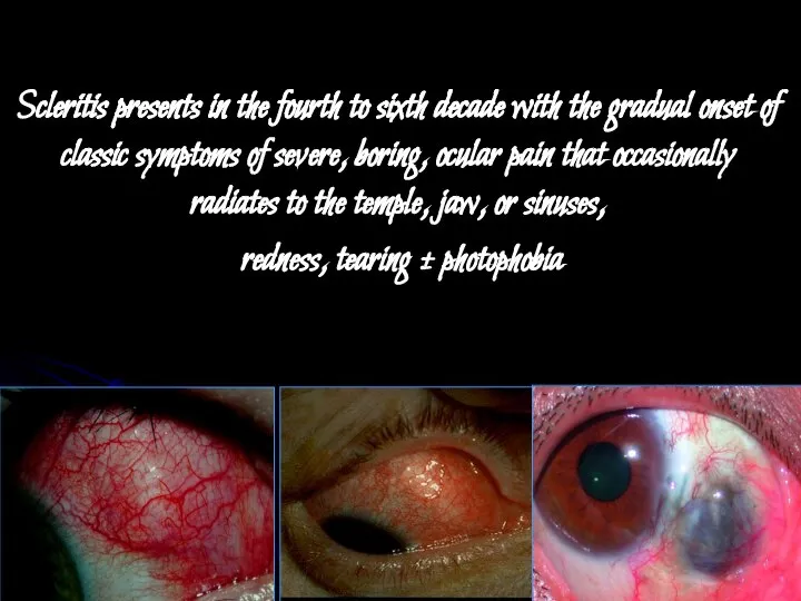 Scleritis presents in the fourth to sixth decade with the gradual onset