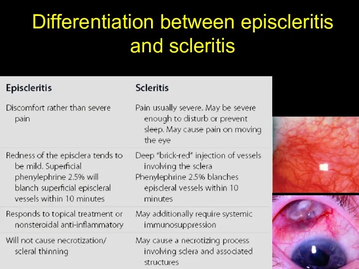 Differentiation between episcleritis and scleritis