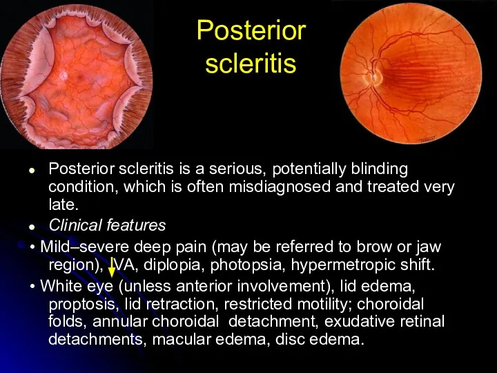 Posterior scleritis Posterior scleritis is a serious, potentially blinding condition, which is