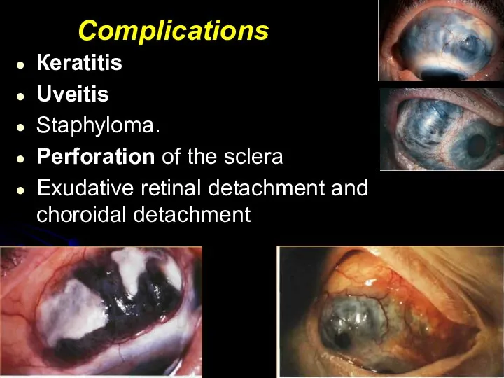 Complications Кeratitis Uveitis Staphyloma. Perforation of the sclera Exudative retinal detachment and choroidal detachment