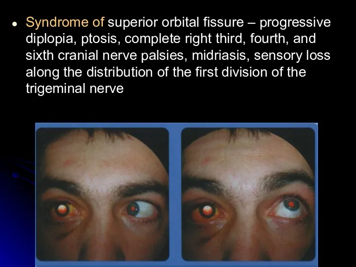 Syndrome of superior orbital fissure – progressive diplopia, ptosis, complete right third,