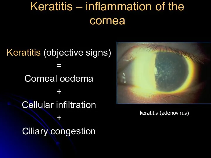 Keratitis – inflammation of the cornea Keratitis (objective signs) = Corneal oedema
