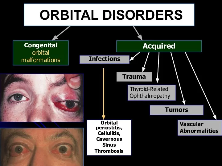ORBITAL DISORDERS Congenital orbital malformations Infections Orbital periostitis, Cellulitis, Cavernous Sinus Thrombosis