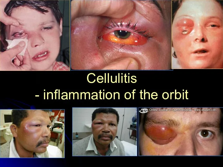 Cellulitis - inflammation of the orbit