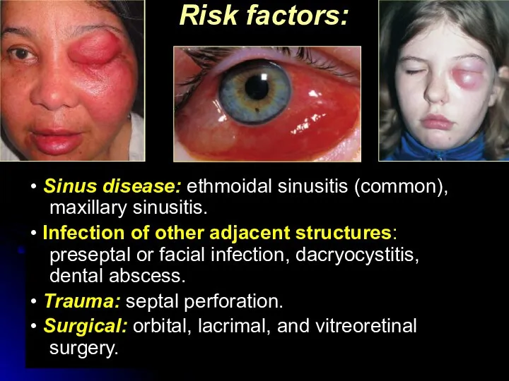 Risk factors: • Sinus disease: ethmoidal sinusitis (common), maxillary sinusitis. • Infection