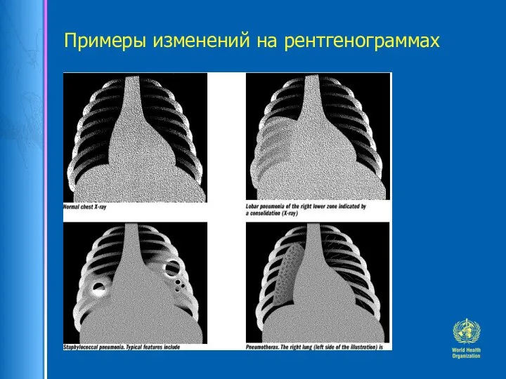 Примеры изменений на рентгенограммах