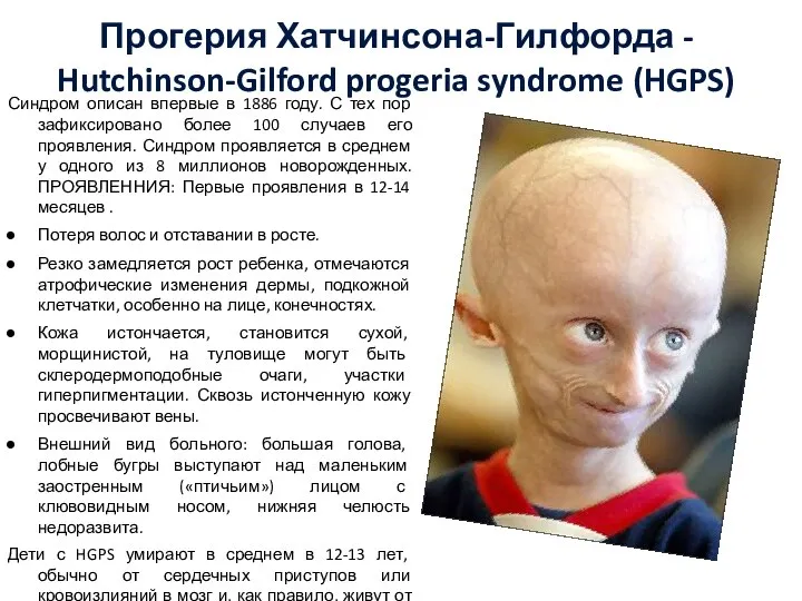 Прогерия Хатчинсона-Гилфорда - Hutchinson-Gilford progeria syndrome (HGPS) Синдром описан впервые в 1886