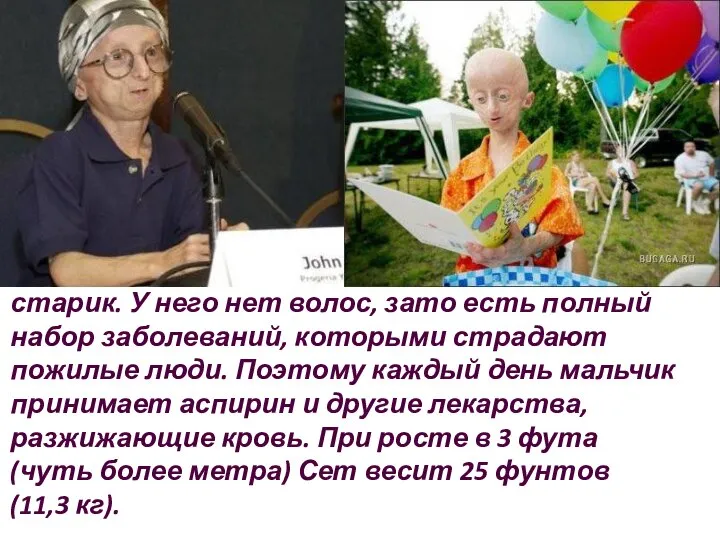 12-летний Сет Кук выглядит как 80-летний старик. У него нет волос, зато