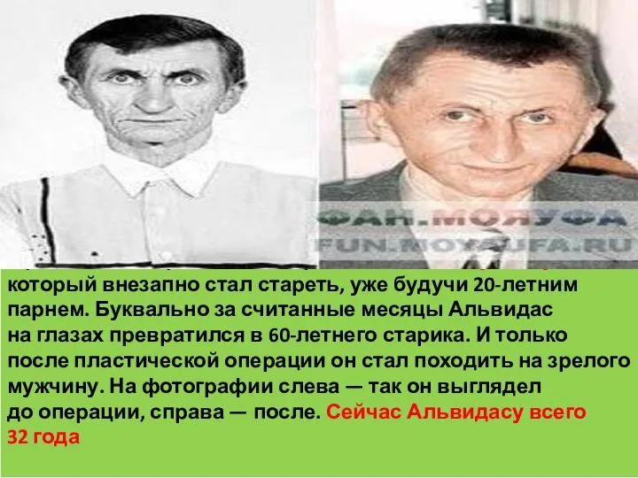 Самый известный случай прогерии, описанный в российской прессе — история Альвидаса Гуделяускаса,