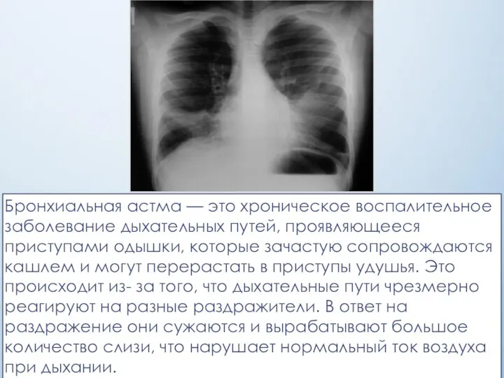 Бронхиальная астма — это хроническое воспалительное заболевание дыхательных путей, проявляющееся приступами одышки,