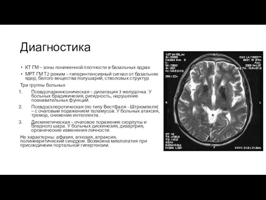 Диагностика КТ ГМ – зоны пониженной плотности в базальных ядрах МРТ ГМ