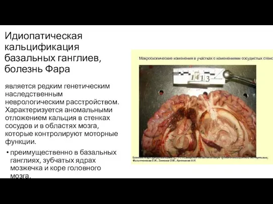 Идиопатическая кальцификация базальных ганглиев, болезнь Фара является редким генетическим наследственным неврологическим расстройством.