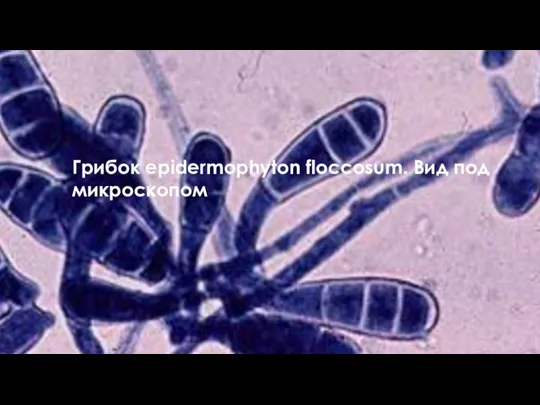 Грибок еpidermophyton floccosum. Вид под микроскопом Грибок еpidermophyton floccosum. Вид под микроскопом