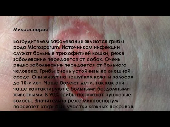 Микроспория Возбудителем заболевания являются грибы рода Microsporum. Источником инфекции служат больные трихофитией