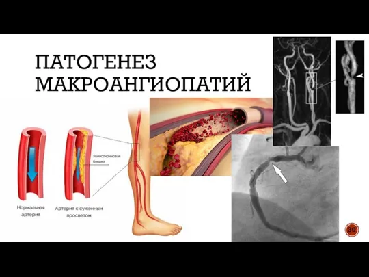 ПАТОГЕНЕЗ МАКРОАНГИОПАТИЙ 30