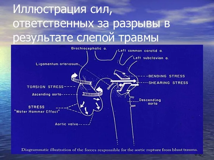 6688 Иллюстрация сил, ответственных за разрывы в результате слепой травмы