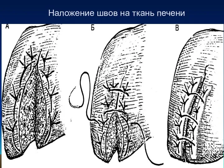 Наложение швов на ткань печени