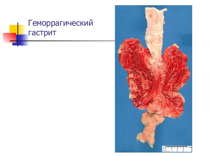 Геморрагический гастрит