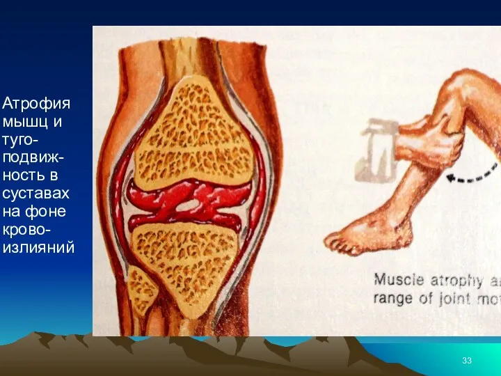 Атрофия мышц и туго-подвиж-ность в суставах на фоне крово-излияний