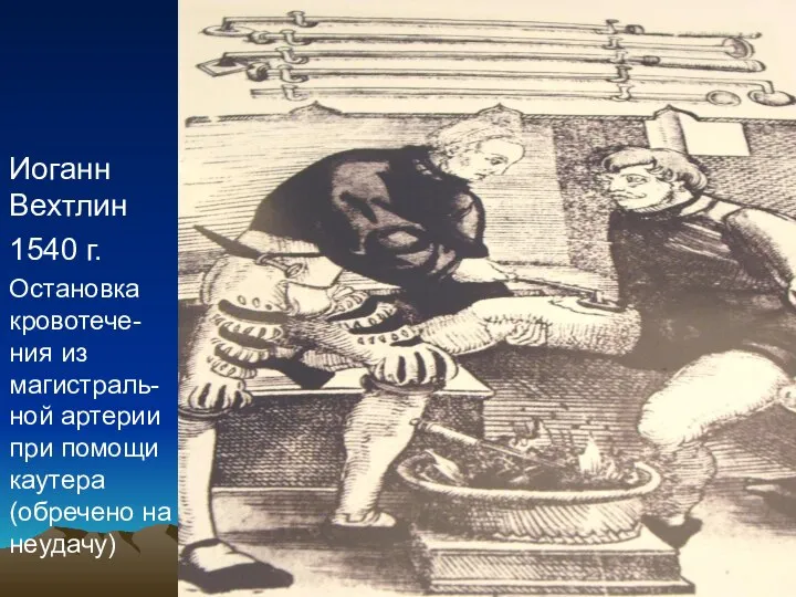 Иоганн Вехтлин 1540 г. Остановка кровотече-ния из магистраль-ной артерии при помощи каутера (обречено на неудачу)