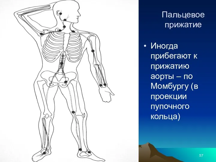 Пальцевое прижатие Иногда прибегают к прижатию аорты – по Момбургу (в проекции пупочного кольца)