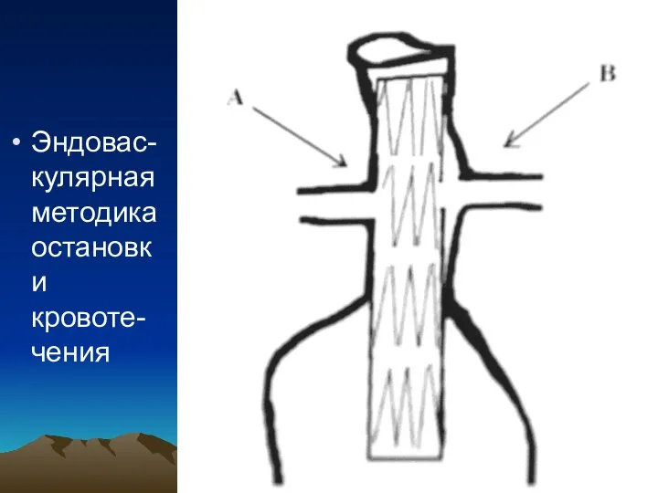 Эндовас-кулярная методика остановки кровоте-чения