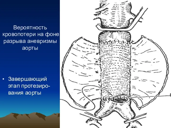 Вероятность кровопотери на фоне разрыва аневризмы аорты Завершающий этап протезиро-вания аорты
