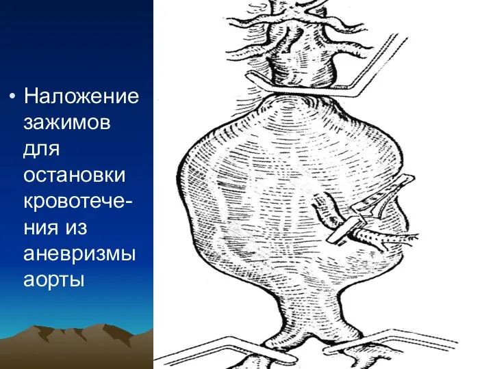 Наложение зажимов для остановки кровотече-ния из аневризмы аорты