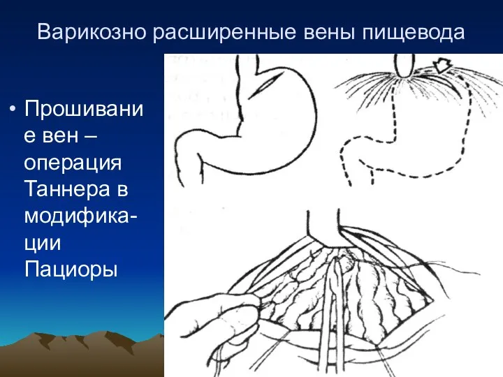 Варикозно расширенные вены пищевода Прошивание вен – операция Таннера в модифика-ции Пациоры