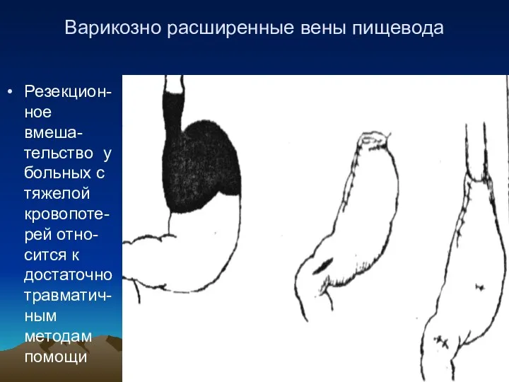 Варикозно расширенные вены пищевода Резекцион-ное вмеша-тельство у больных с тяжелой кровопоте-рей отно-сится