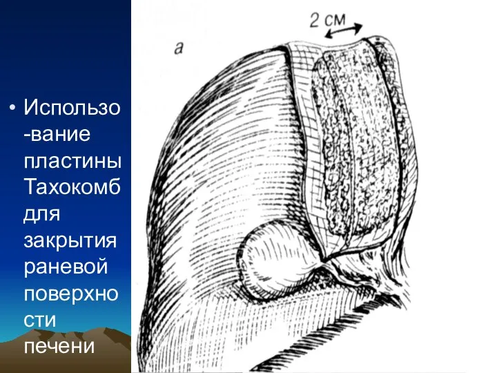 Использо-вание пластины Тахокомб для закрытия раневой поверхности печени