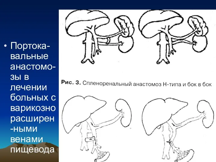 Портока-вальные анастомо-зы в лечении больных с варикозно расширен-ными венами пищевода