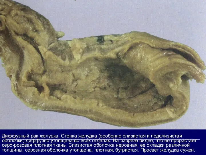 Диффузный рак желудка. Стенка желудка (особенно слизистая и подслизистая оболочки) диффузно утолщена