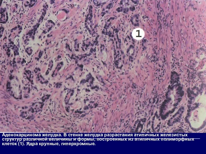 Аденокарцинома желудка. В стенке желудка разрастания атипичных железистых структур различной величины и