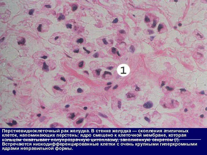 Перстневидноклеточный рак желудка. В стенке желудка — скопления атипичных клеток, напоминающих перстень: