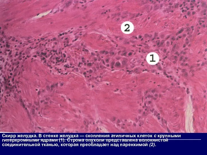 Скирр желудка. В стенке желудка — скопления атипичных клеток с крупными гиперхромными