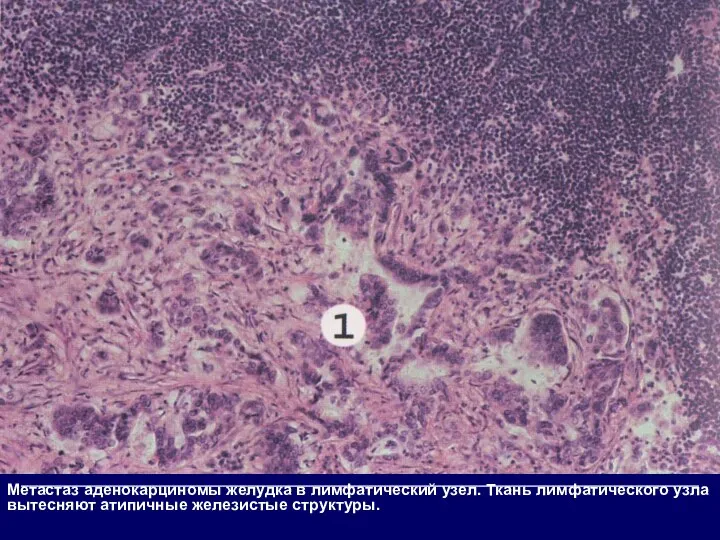 Метастаз аденокарциномы желудка в лимфатический узел. Ткань лимфатического узла вытесняют атипичные железистые структуры.