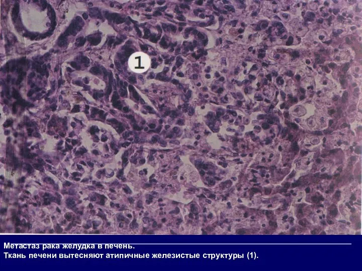 Метастаз рака желудка в печень. Ткань печени вытесняют атипичные железистые структуры (1).