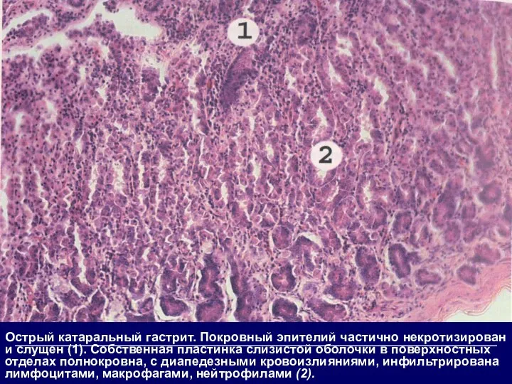 Острый катаральный гастрит. Покровный эпителий частично некротизирован и слущен (1). Собственная пластинка