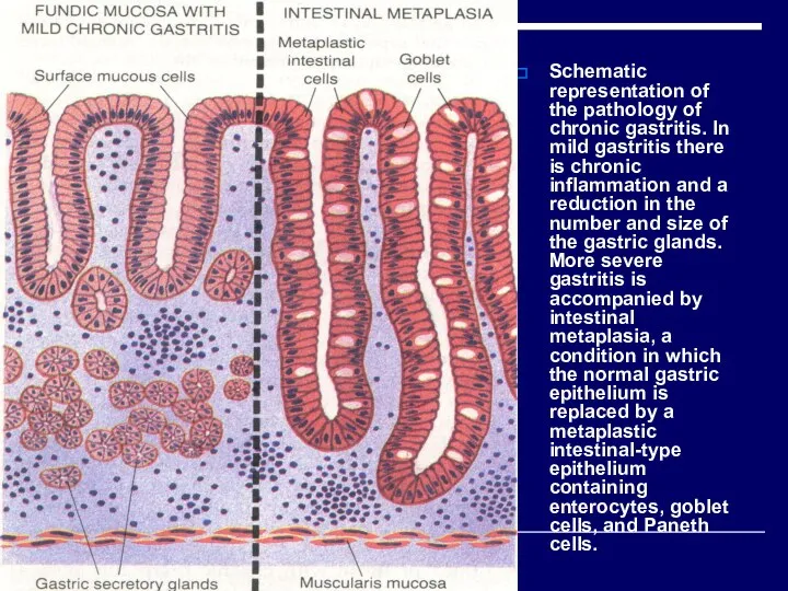 Schematic representation of the pathology of chronic gastritis. In mild gastritis there