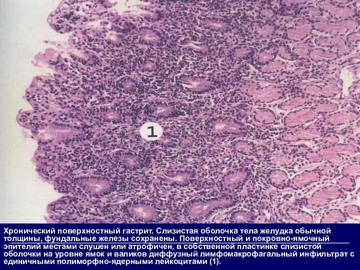 Хронический поверхностный гастрит. Слизистая оболочка тела желудка обычной толщины, фундальные железы сохранены.