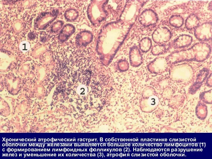 Хронический атрофический гастрит. В собственной пластинке слизистой оболочки между железами выявляется большое