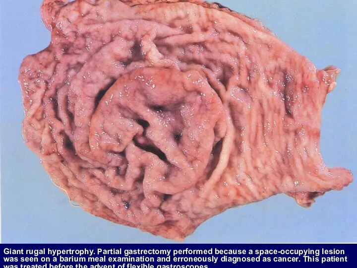 Giant rugal hypertrophy. Partial gastrectomy performed because a space-occupying lesion was seen