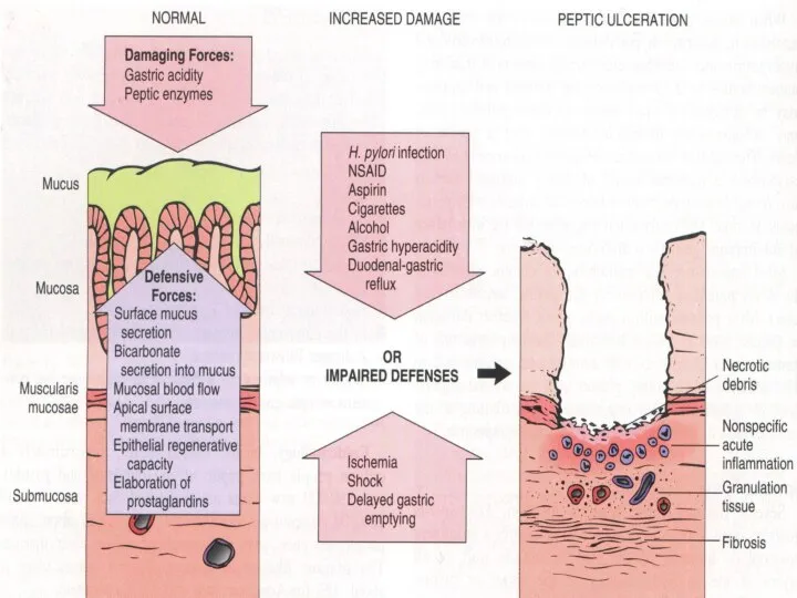 Diagram of aggravating causes of, and defense mechanisms against, peptic ulceration.