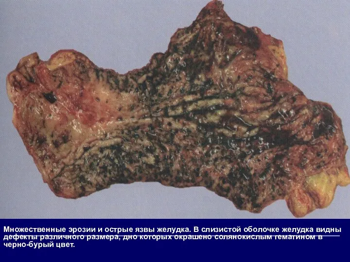 Множественные эрозии и острые язвы желудка. В слизистой оболочке желудка видны дефекты