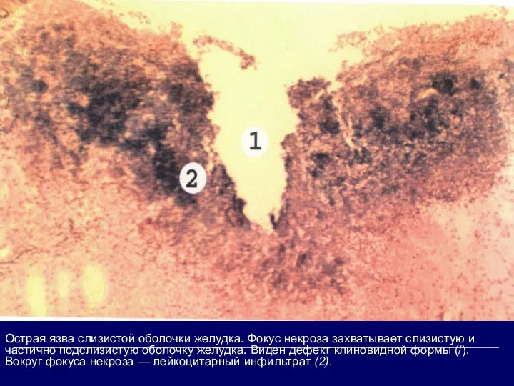 Острая язва слизистой оболочки желудка. Фокус некроза захватывает слизистую и частично подслизистую