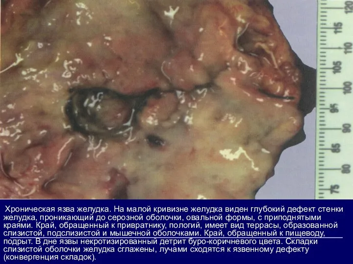 Хроническая язва желудка. На малой кривизне желудка виден глубокий дефект стенки желудка,