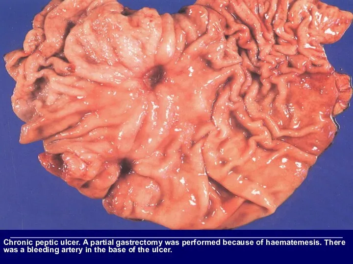 Chronic peptic ulcer. A partial gastrectomy was performed because of haematemesis. There